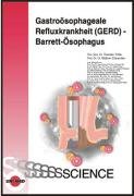 Gastroösophageale Refluxkrankheit (GERD) - Barrett-Ösophagus